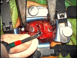C4-5 Disk Space - Cervical Dicsectomy