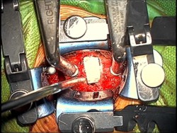 Removal of Disk - Cervical Discectomy