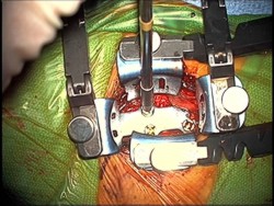 Cervical Discectomy back bone