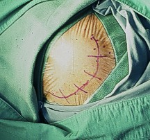 craniotomy - surgery craniotomy - surgery