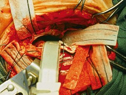 craniotomy - surgery craniotomy - surgery