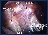 ganglion hyperhidrosis