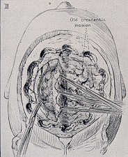 Meningiomas