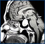 Pituitary Compressing Pituitary Compressing