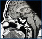 Pituitary Compressing