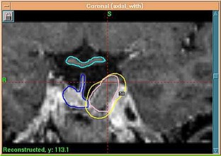 Gamma Knife Treatment Gamma Knife Treatment