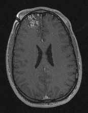 Arteriovenous Malformations Arteriovenous Malformations