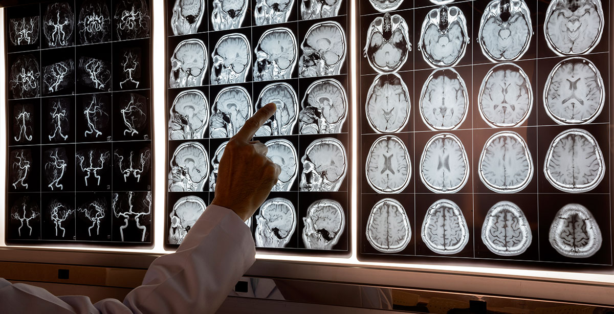 Slide Image of Doctor pointing at MRI of human brain on the light box to demonstrate anatomy